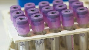Análisis de sangre para detectar precozmente el autismo