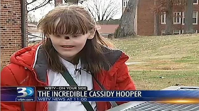 Cassidy Hooper La Adolescente De Ee Uu Que No Tiene Ojos Ni Nariz