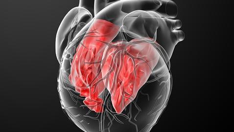 La miocardiopatía dilatada produce un engrosamiento del corazón