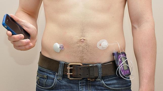 nombres alternativos para la diabetes tipo 1