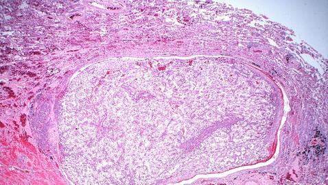La metástasis es la principal causa de muerte en cáncer, pero la mayoría de los fármacos solo se dirigen a tumores primarios