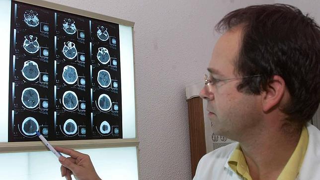 Las seis señales de alarma del ictus