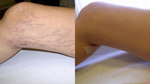 Piernas en las vasculares para arañas eliminar costo las
