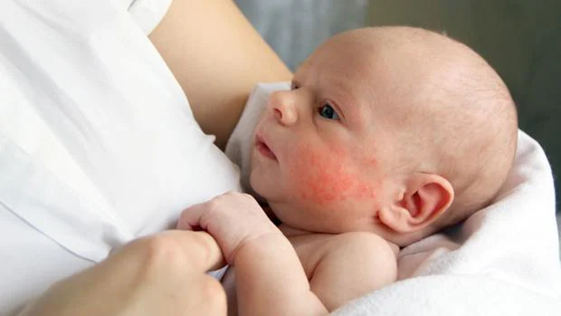 El Virus Del Herpes Labial Puede Producir Secuelas Neurologicas En Los Recien Nacidos De Manera Excepcional
