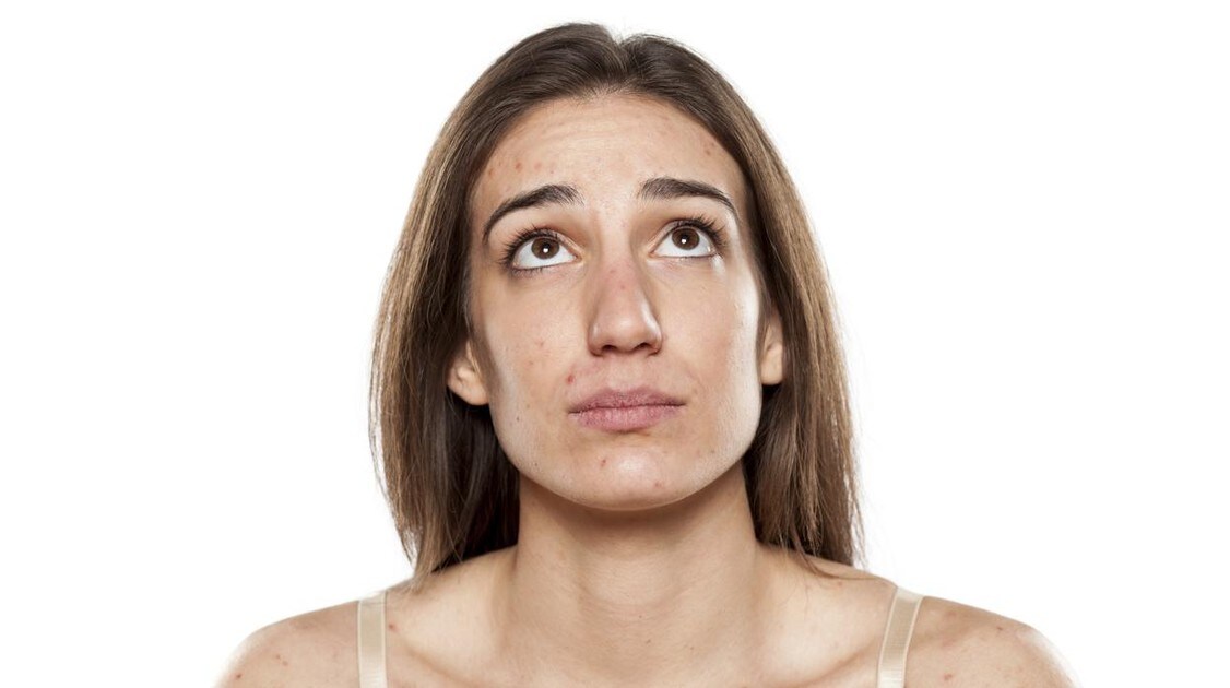 Las Claves Para Que El Acne No Afecte Tanto Psicologicamente