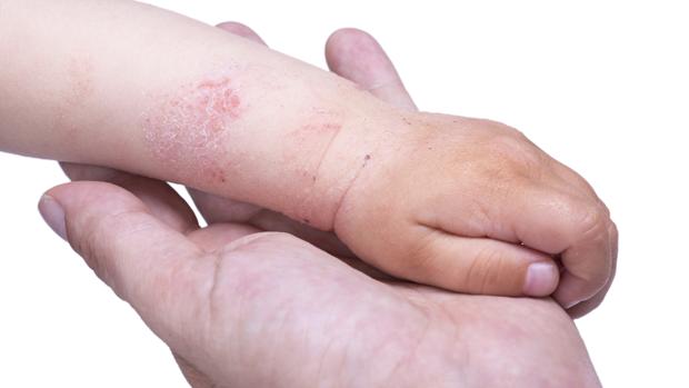 Dermatitis atopica alimentacion sana
