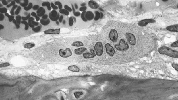 prostata como evitar cancer