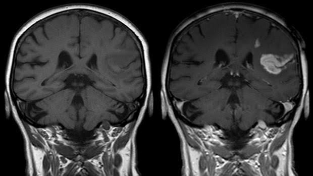 Trombosis cerebral por cirugía de próstata. Trombosis cerebral por cirugía de próstata.