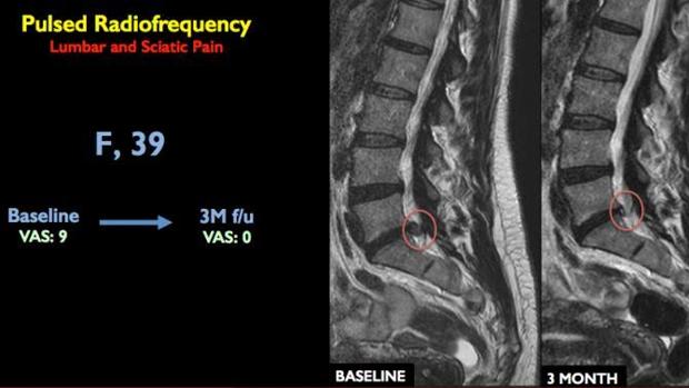Cronico medicamentos para el dolor lumbar