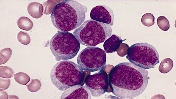 Leucemia buena