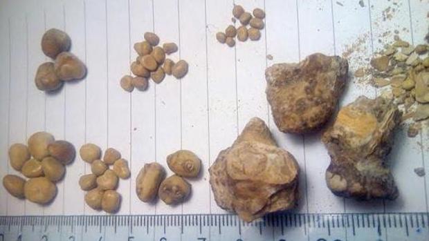 Que te causa las piedras en los rinones