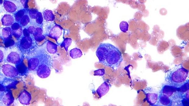Células de melanoma