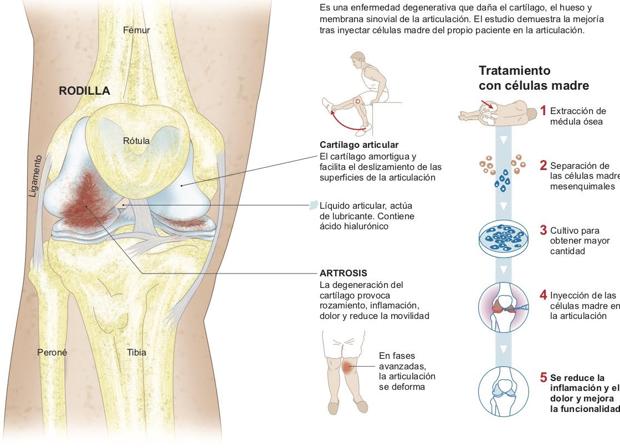Liquido en la rodilla cuanto tiempo de recuperacion