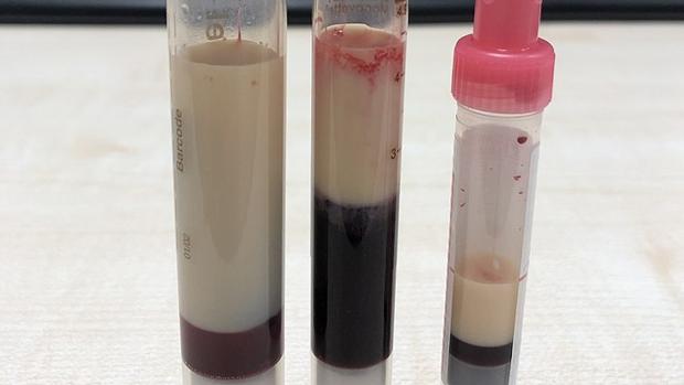 Ejemplo de hipertrigliceridemia en sangre
