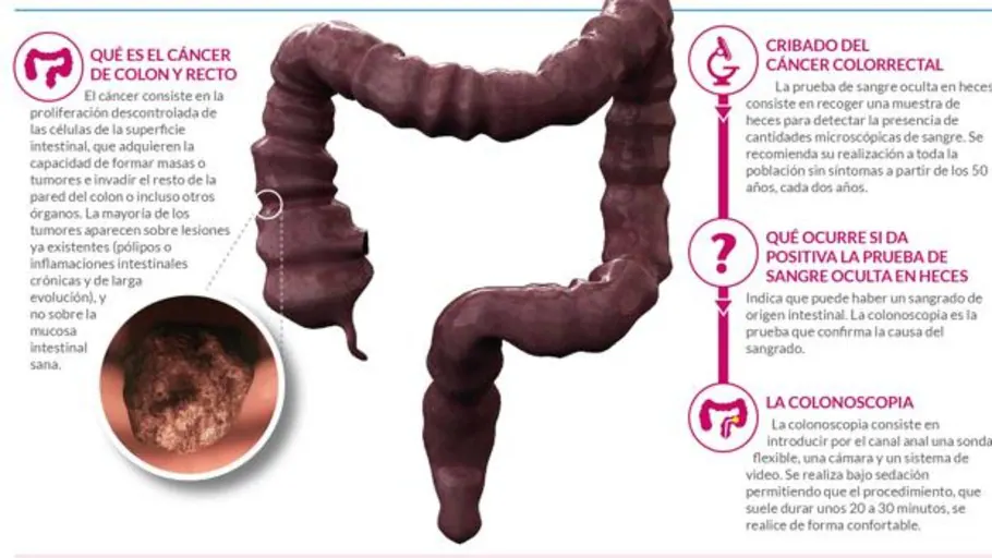 Cancer de colon juvenil. curs cancerul de colon