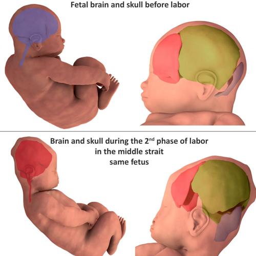 El cerebro y el cráneo antes del parto (arriba) y durante la segunda fase del parto (abajo)