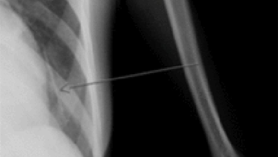 Le colocan un implante anticonceptivo en el brazo y se le va al pulmón