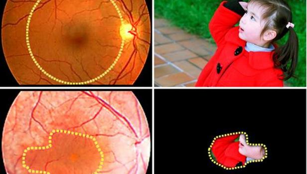 Uno de los síntomas de la retinosis pigmentaria es la visión en túnel
