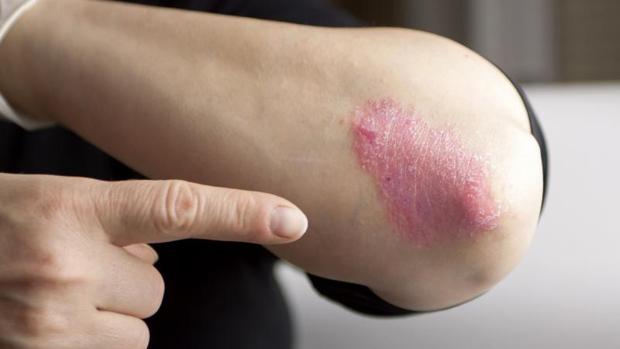 Psoriasis pustular de palmas y plantas