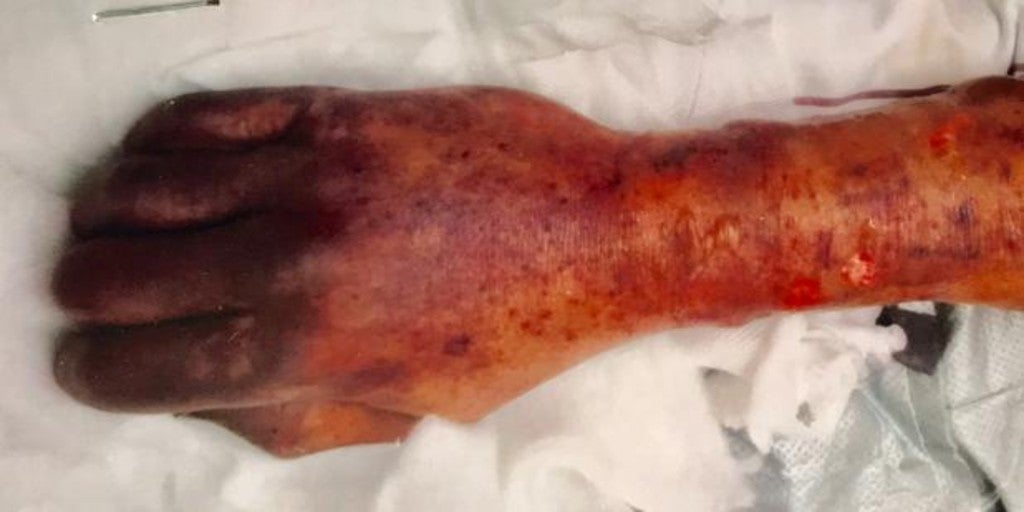 Muere por una infección rara tras un lametón de su perro