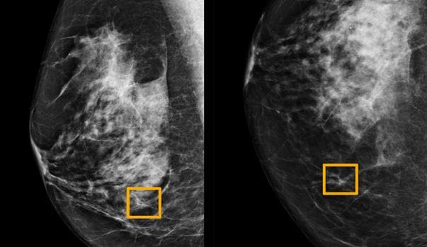 La IA de Google detecta el cáncer de mama mejor que los radiólogos más expertos Mamogram-kGoE--620x349@abc