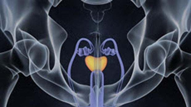modelo 2020 del cáncer de próstata modelo 2020 del cáncer de próstata