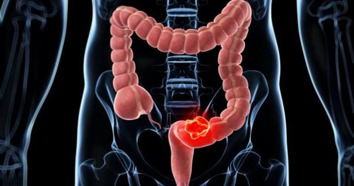 cancer de colon hombres sintomas