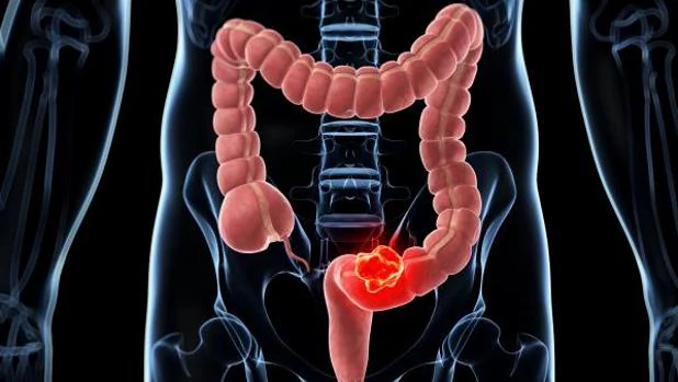 Cancer de colon. Tratament, alimentatie corecta, simptome cancer de colon.