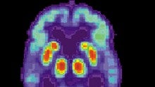 Pet de un cerebro con Alzheimer
