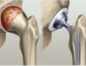 Hip with osteoarthritis and hip following implanting a total hip replacement ..