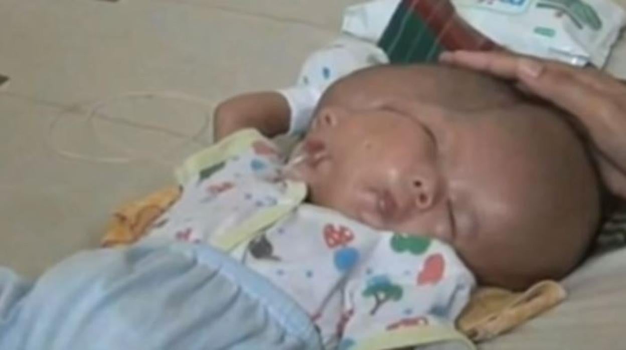 Un Bebe Nace Con Dos Caras Y Dos Cerebros Despues De Que Su Gemelo No Se Desarrollara