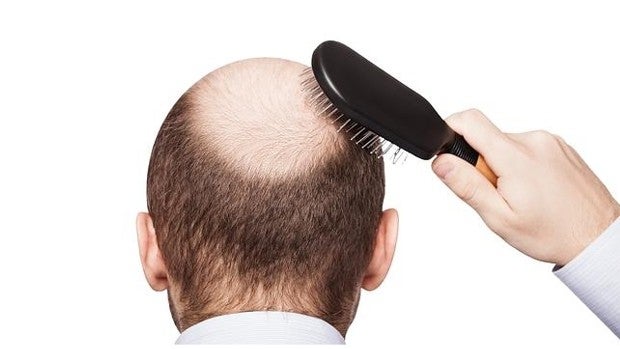 https://static2.abc.es/media/sociedad/2022/05/14/alopecia-calvicie-U38136125288RmR-620x349@abc.jpg